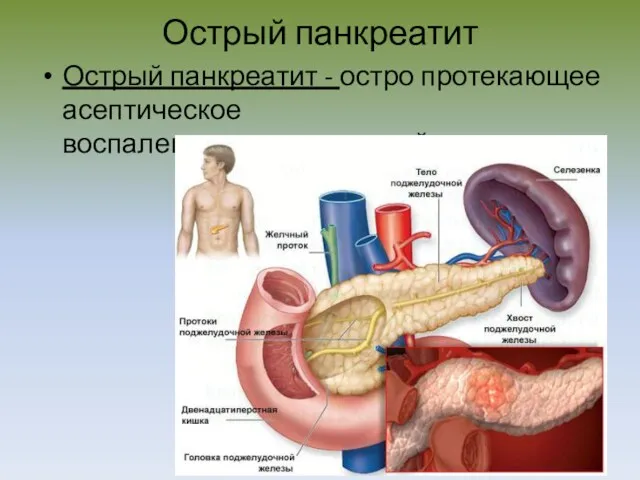 Острый панкреатит Острый панкреатит - остро протекающее асептическое воспаление поджелудочной железы