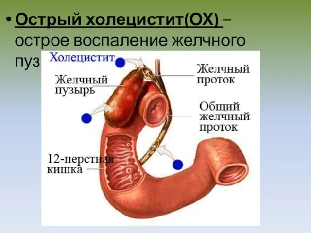 Острый холецистит(ОХ) – острое воспаление желчного пузыря.