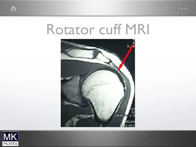 Rotator cuff MRI