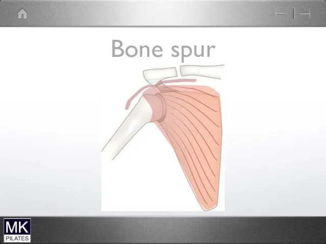 Bone spur