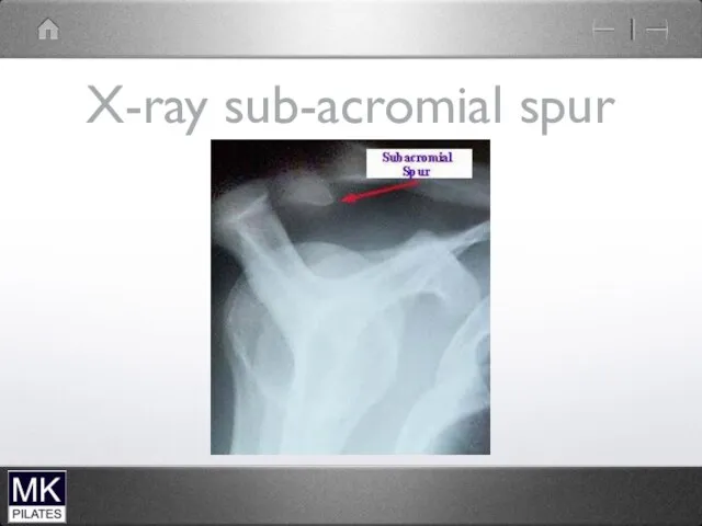 X-ray sub-acromial spur