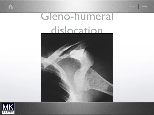 Gleno-humeral dislocation