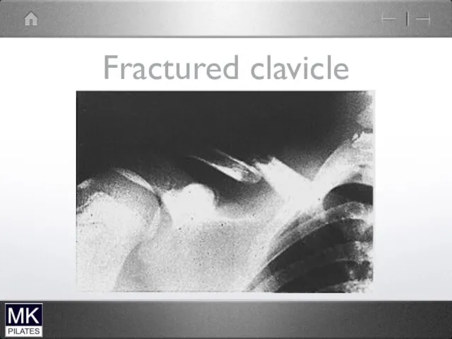 Fractured clavicle