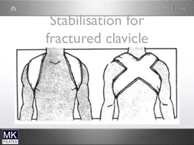 Stabilisation for fractured clavicle