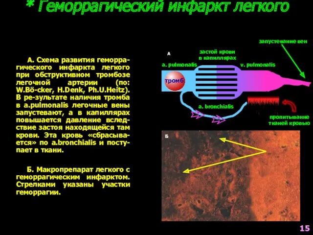 * Геморрагический инфаркт легкого А a. pulmonalis v. pulmonalis a.