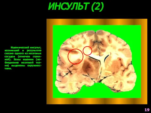 ИНСУЛЬТ (2) Ишемический инсульт, возникший в результате спазма одного из