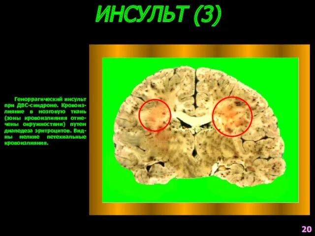 ИНСУЛЬТ (3) Геморрагический инсульт при ДВС-синдроме. Кровоиз-лияние в мозговую ткань