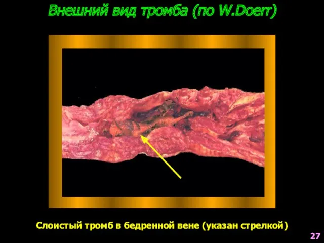 Внешний вид тромба (по W.Doerr) Слоистый тромб в бедренной вене (указан стрелкой) 27