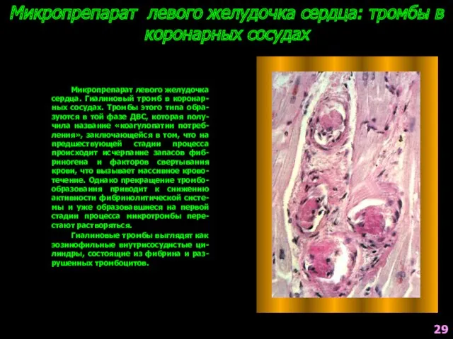 Микропрепарат левого желудочка сердца: тромбы в коронарных сосудах Микропрепарат левого