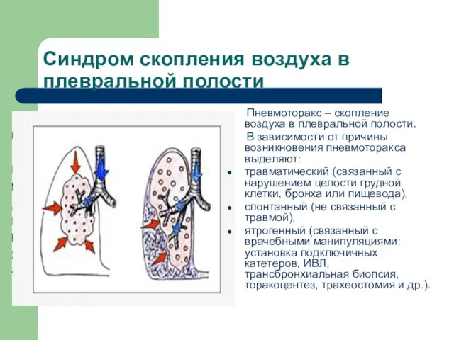 Синдром скопления воздуха в плевральной полости Пневмоторакс – скопление воздуха