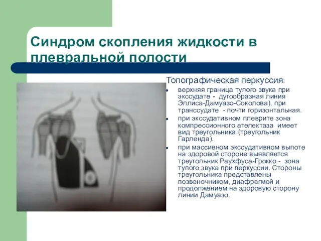 Синдром скопления жидкости в плевральной полости Топографическая перкуссия: верхняя граница