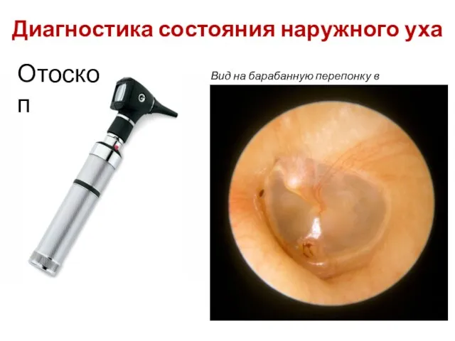 Диагностика состояния наружного уха Отоскоп Вид на барабанную перепонку в отоскоп: