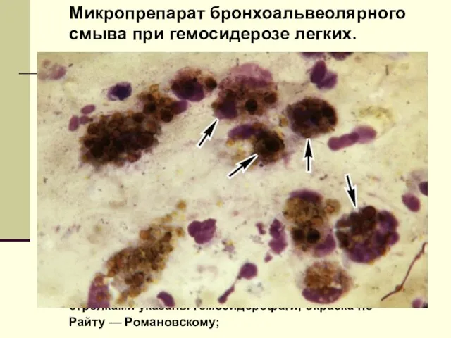 Микропрепарат бронхоальвеолярного смыва при гемосидерозе легких. стрелками указаны гемосидерофаги; окраска по Райту — Романовскому;