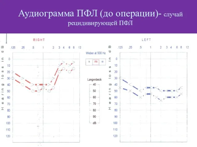 Аудиограмма ПФЛ (до операции)- случай рецидивирующей ПФЛ