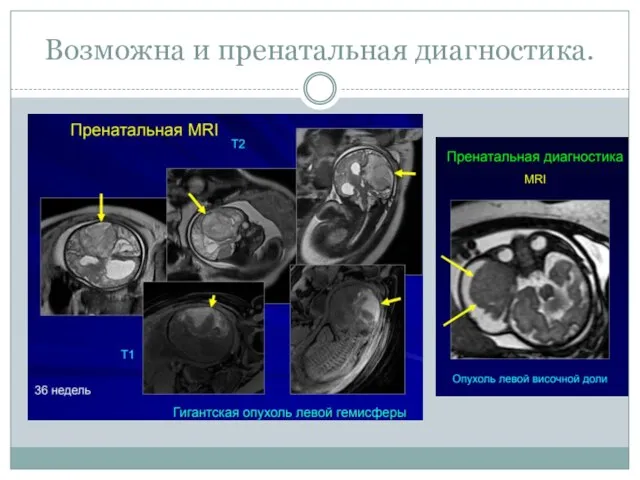 Возможна и пренатальная диагностика.