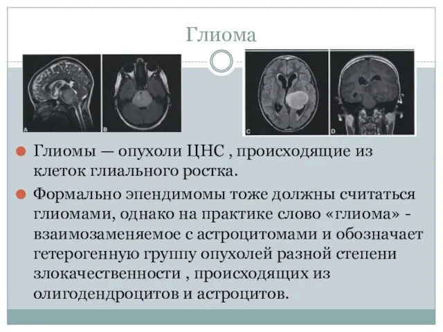 Глиома Глиомы — опухоли ЦНС , происходящие из клеток глиального