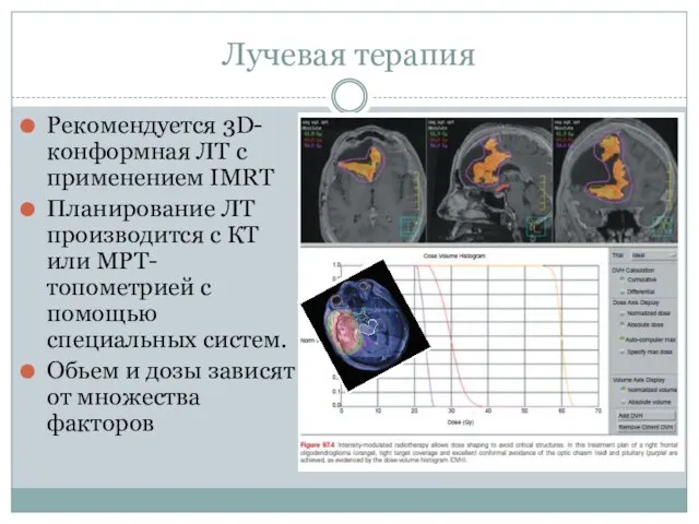 Лучевая терапия Рекомендуется 3D-конформная ЛТ с применением IMRT Планирование ЛТ