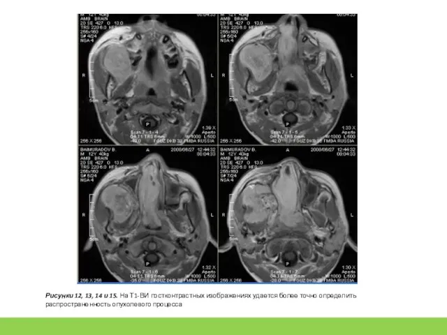 Рисунки 12, 13, 14 и 15. На Т1-ВИ постконтрастных изображениях