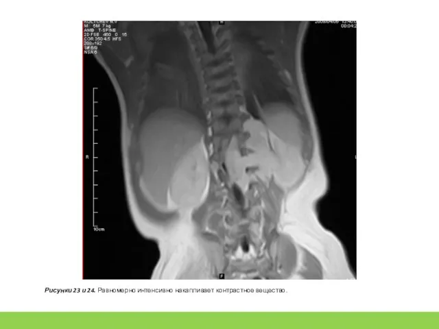 Рисунки 23 и 24. Равномерно интенсивно накапливает контрастное вещество.