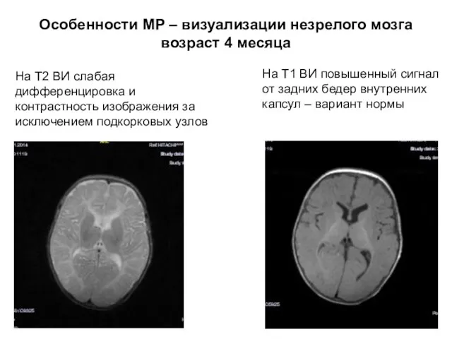 Особенности МР – визуализации незрелого мозга возраст 4 месяца На