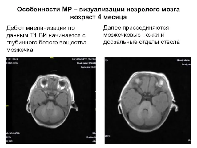 Особенности МР – визуализации незрелого мозга возраст 4 месяца Дебют