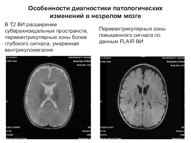 Особенности диагностики патологических изменений в незрелом мозге В Т2 ВИ