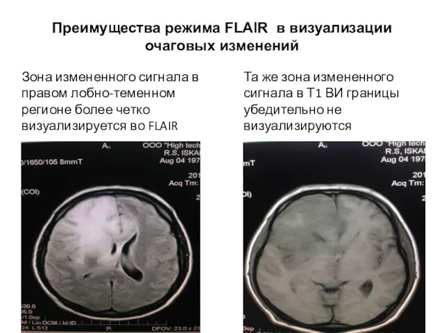 Преимущества режима FLAIR в визуализации очаговых изменений Зона измененного сигнала