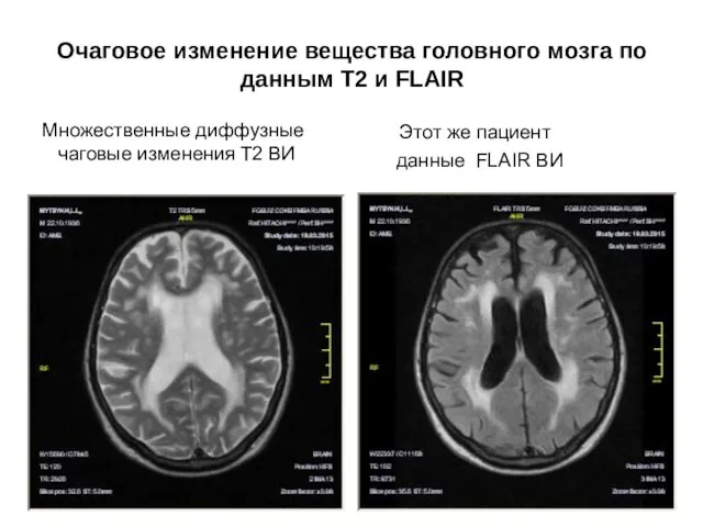 Очаговое изменение вещества головного мозга по данным Т2 и FLAIR