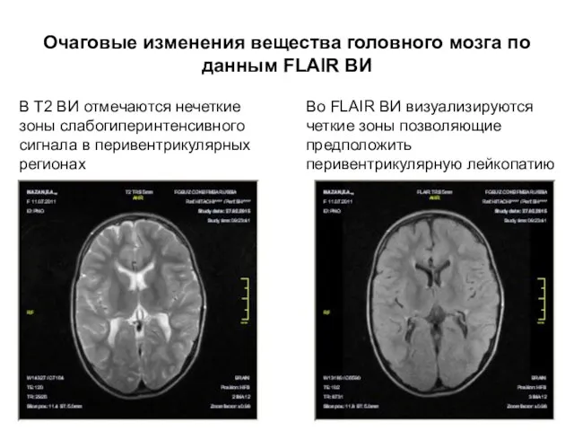 Очаговые изменения вещества головного мозга по данным FLAIR ВИ В