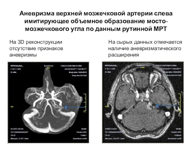 Аневризма верхней мозжечковой артерии слева имитирующее объемное образование мосто-мозжечкового угла