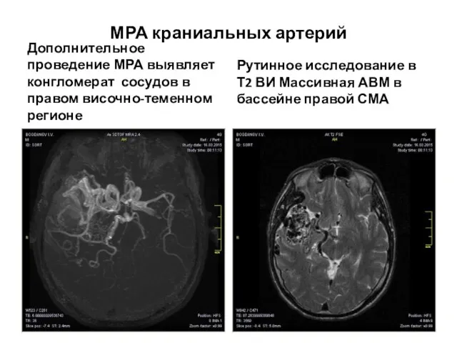 МРА краниальных артерий Дополнительное проведение МРА выявляет конгломерат сосудов в