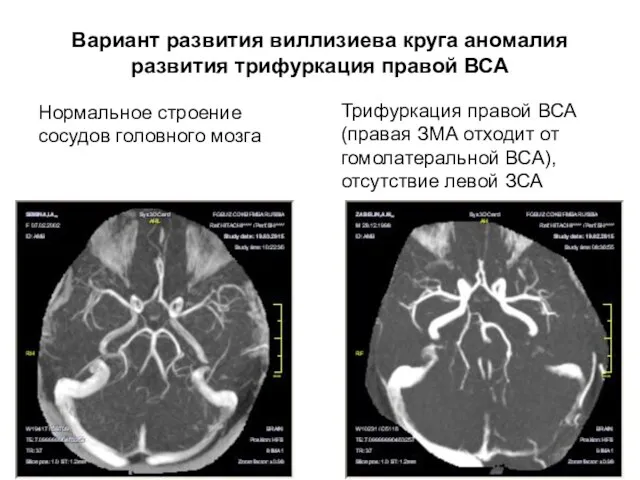 Вариант развития виллизиева круга аномалия развития трифуркация правой ВСА Нормальное