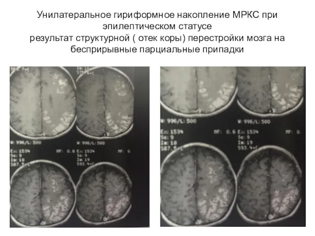 Унилатеральное гириформное накопление МРКС при эпилептическом статусе результат структурной (