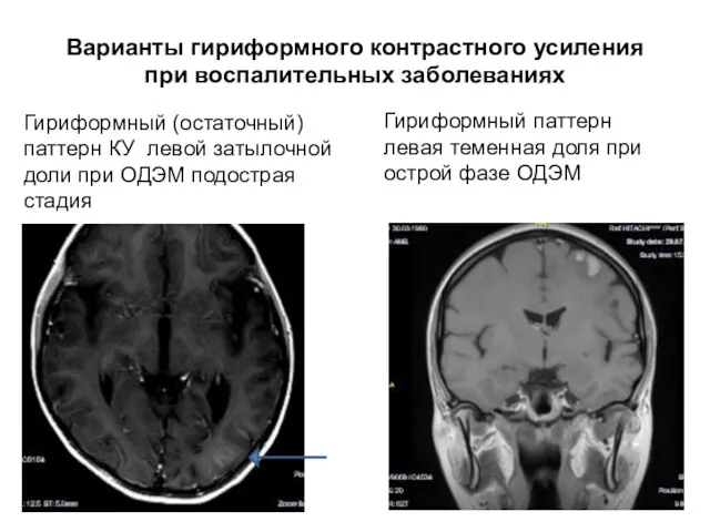 Варианты гириформного контрастного усиления при воспалительных заболеваниях Гириформный (остаточный) паттерн