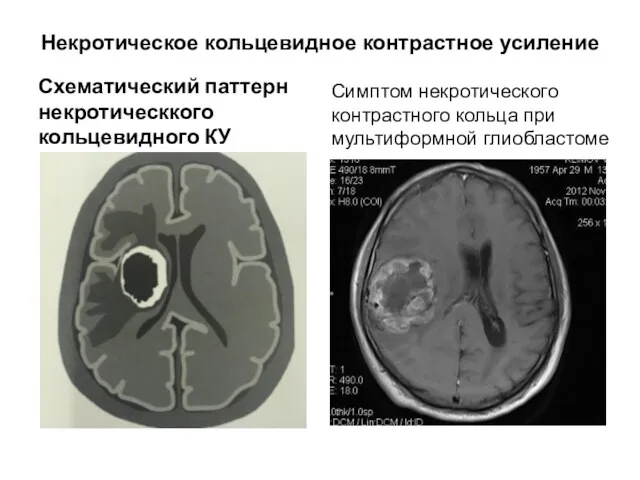 Некротическое кольцевидное контрастное усиление Схематический паттерн некротическкого кольцевидного КУ Симптом некротического контрастного кольца при мультиформной глиобластоме