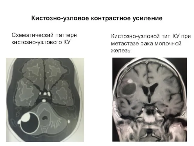 Кистозно-узловое контрастное усиление Схематический паттерн кистозно-узлового КУ Кистозно-узловой тип КУ при метастазе рака молочной железы