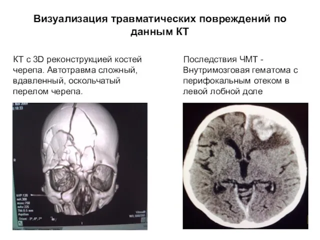 Визуализация травматических повреждений по данным КТ КТ с 3D реконструкцией