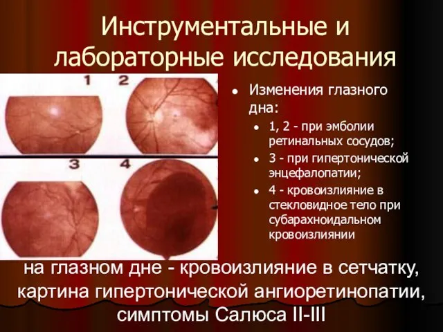 Инструментальные и лабораторные исследования Изменения глазного дна: 1, 2 -