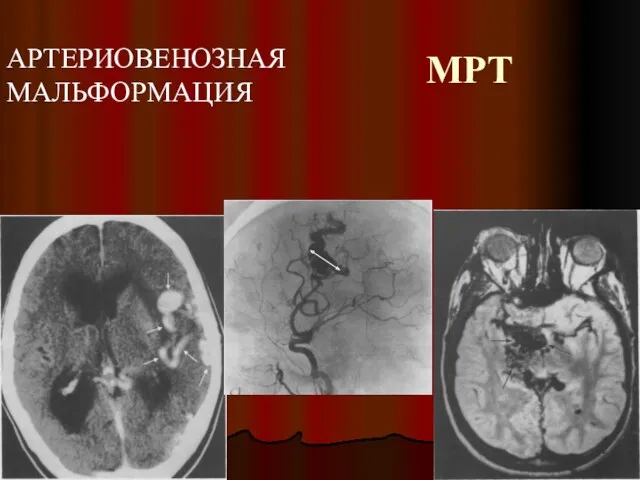 МРТ АРТЕРИОВЕНОЗНАЯ МАЛЬФОРМАЦИЯ