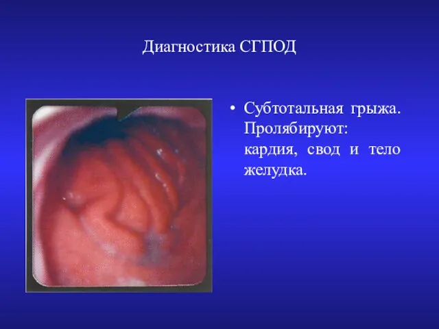 Диагностика СГПОД Субтотальная грыжа. Пролябируют: кардия, свод и тело желудка.