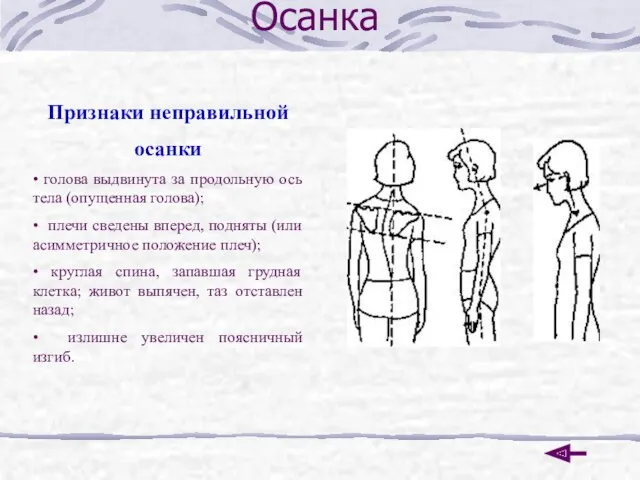 Осанка Признаки неправильной осанки • голова выдвинута за продольную ось тела (опущенная голова);