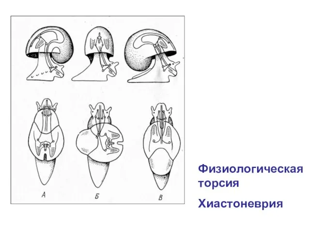 Физиологическая торсия Хиастоневрия