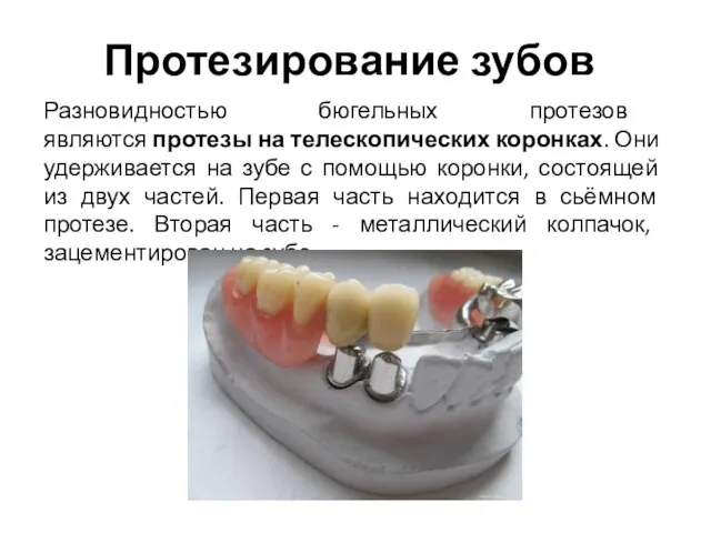 Протезирование зубов Разновидностью бюгельных протезов являются протезы на телескопических коронках. Они удерживается на