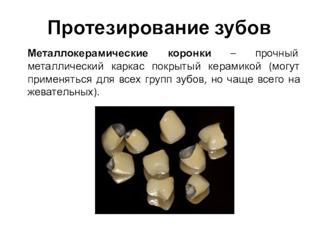Протезирование зубов Металлокерамические коронки – прочный металлический каркас покрытый керамикой (могут применяться для