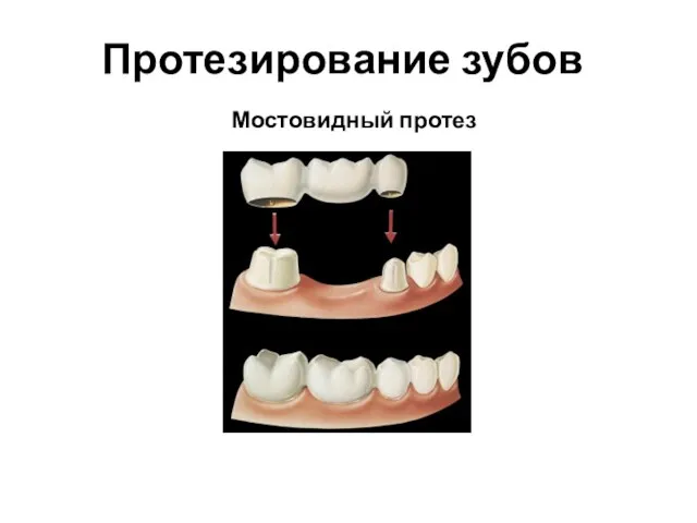 Протезирование зубов Мостовидный протез