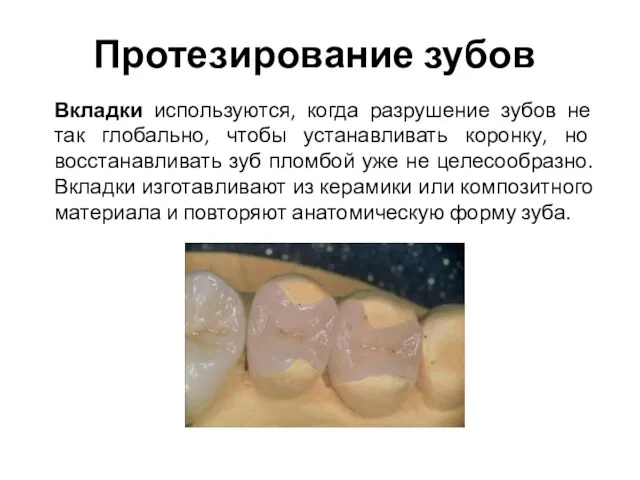 Протезирование зубов Вкладки используются, когда разрушение зубов не так глобально, чтобы устанавливать коронку,
