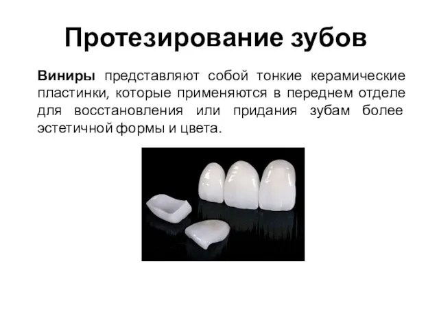 Протезирование зубов Виниры представляют собой тонкие керамические пластинки, которые применяются в переднем отделе