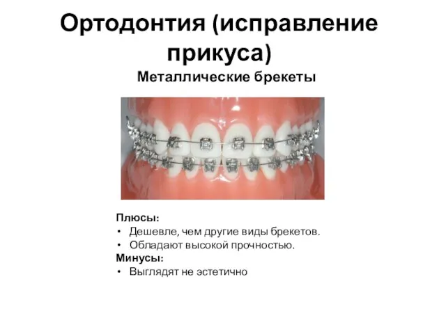 Ортодонтия (исправление прикуса) Металлические брекеты Плюсы: Дешевле, чем другие виды