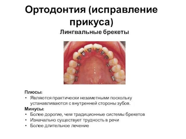 Ортодонтия (исправление прикуса) Лингвальные брекеты Плюсы: Являются практически незаметными поскольку устанавливаются с внутренней