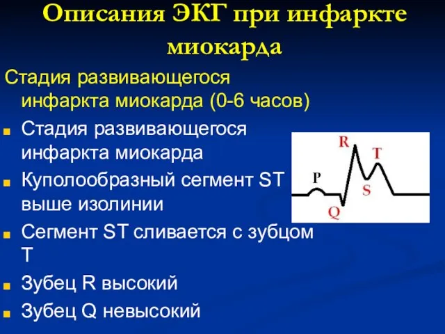 Описания ЭКГ при инфаркте миокарда Стадия развивающегося инфаркта миокарда (0-6